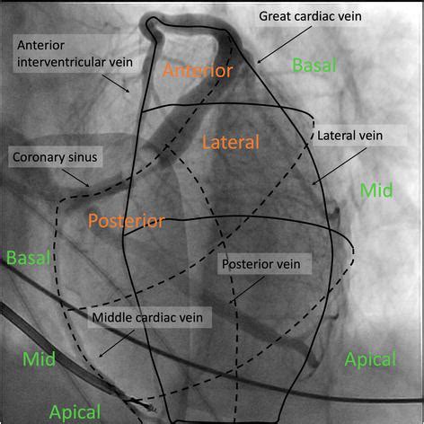 lv lead placement|coronary sinus lead placement.